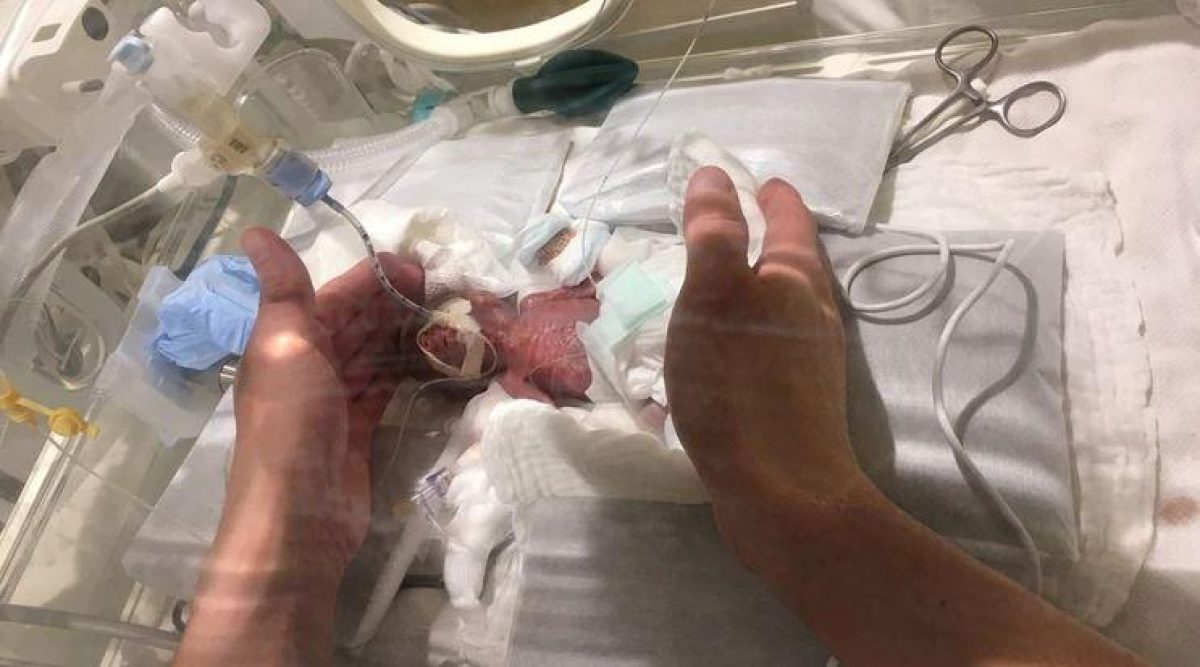 Así estaba el bebé cinco días después de su nacimiento (Keio University School of Medicine, Department of Pediatrics/Reuters)