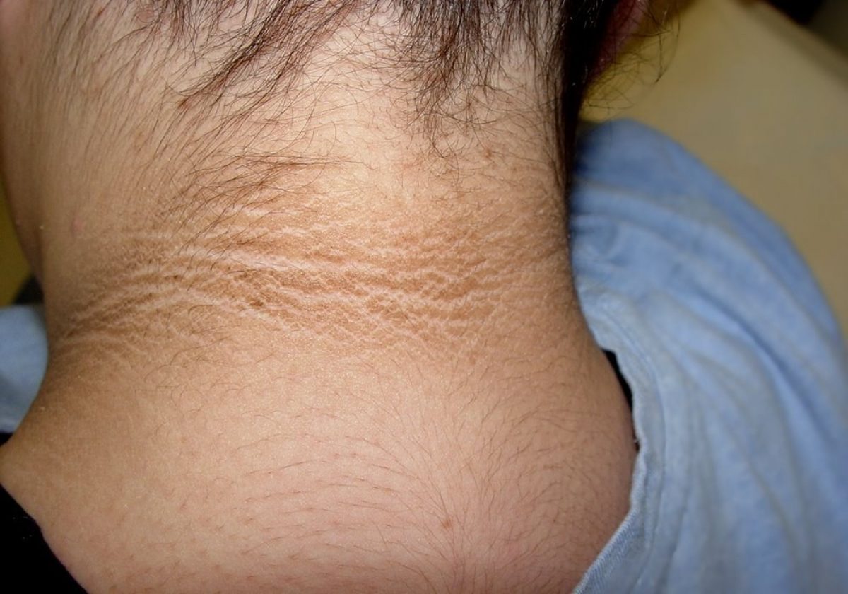 Presentar oscurecimiento en la parte posterior del cuello es un motivo para realizarse una prueba de prediabetes