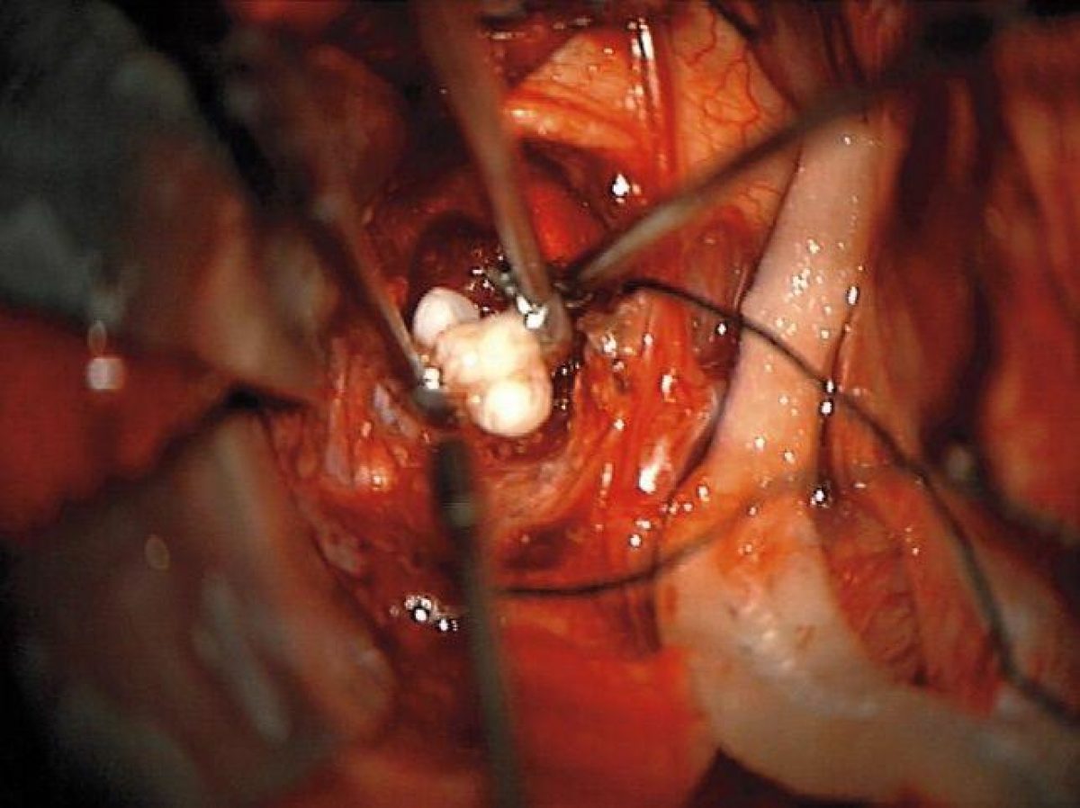 Investigadores señalan que los dientes se habrían desarrollado debido a un extraño tumor llamado craneofaringioma. (nejm.org)