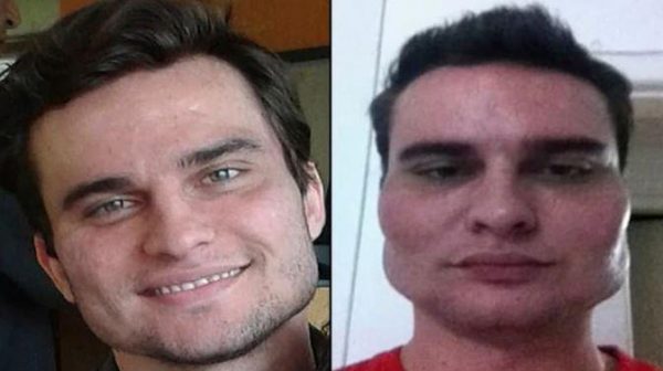 Imagen: Alexandre Garzon, antes y después de someterse a una práctica estética con Wesley Murakami Imagen: Alexandre Garzon, antes y después de someterse a una práctica estética con Wesley Murakami