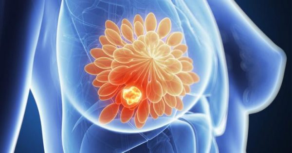 Imagen: El cáncer de mama es una proliferación de células malignas procedente de los conductos y glándulas mamarias. Imagen: El cáncer de mama es una proliferación de células malignas procedente de los conductos y glándulas mamarias.
