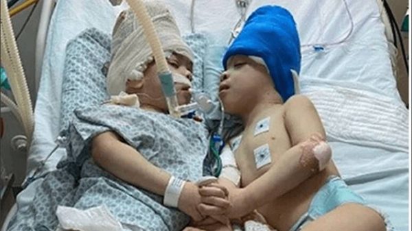 Imagen: Siameses brasileños unidos por la cabeza han sido separados con éxito. Imagen: Siameses brasileños unidos por la cabeza han sido separados con éxito.