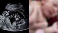 Noticia: IMAGEN SENSIBLE | Nace un bebé con 4 piernas y 3 manos; trillizos se unieron en el útero IMAGEN SENSIBLE | Nace un bebé con 4 piernas y 3 manos; trillizos se unieron en el útero