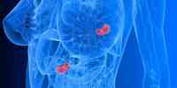 Noticia: Logran detener la metástasis del cáncer de mama con viejos antibióticos y otros fármacos conocidos Logran detener la metástasis del cáncer de mama con viejos antibióticos y otros fármacos conocidos