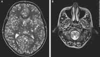 Noticia: Joven murió porque tenía parásitos en el cerebro Joven murió porque tenía parásitos en el cerebro