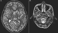 Noticia: Tenía gusanos en el cerebro tras comerse un caldo Tenía gusanos en el cerebro tras comerse un caldo