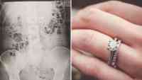 Noticia: FOTOS | Soñó con haberse tragado su anillo de compromiso y se da cuenta de que sí lo hizo FOTOS | Soñó con haberse tragado su anillo de compromiso y se da cuenta de que sí lo hizo
