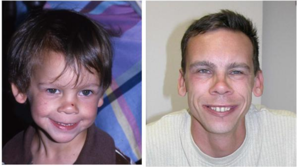 El síndrome de Williams se relaciona con una microdeleción en el cromosoma 7 y puede influir en rasgos sociales y de desarrollo.