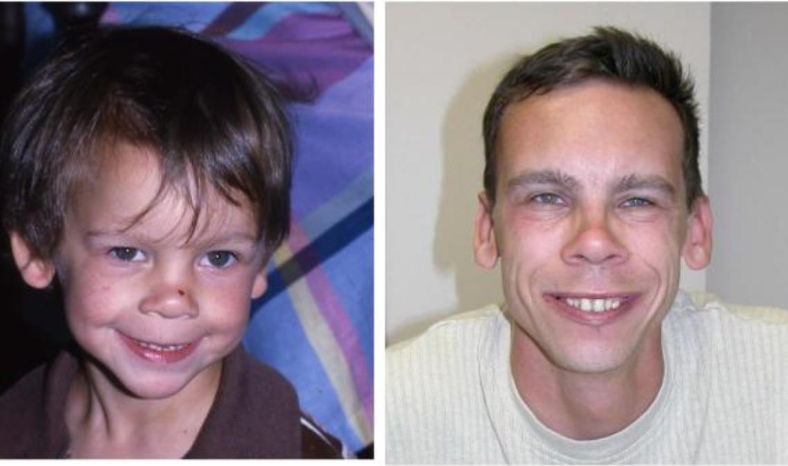 El síndrome de Williams se relaciona con una microdeleción en el cromosoma 7 y puede influir en rasgos sociales y de desarrollo.